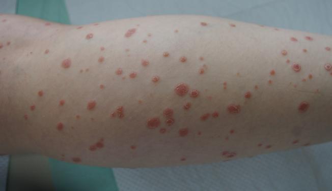 psoriasis guttata